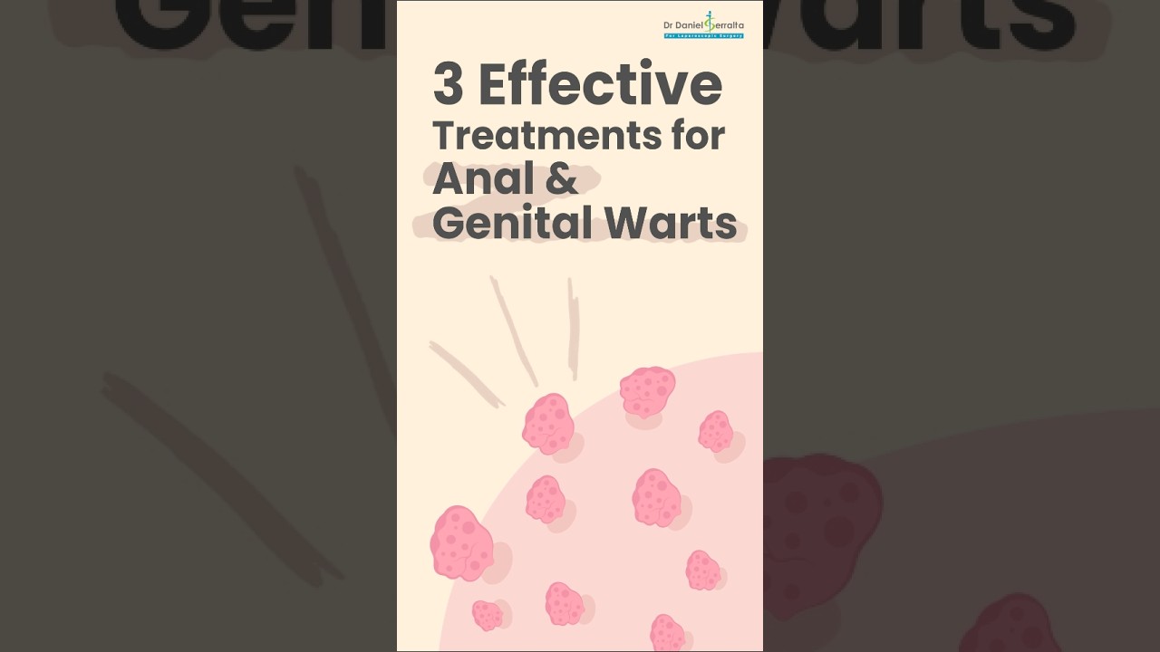 3 Best Treatments for Anal & Genital Warts &ndash; Expert Advice by Dr. Daniel Serrelta #healthtips #uae