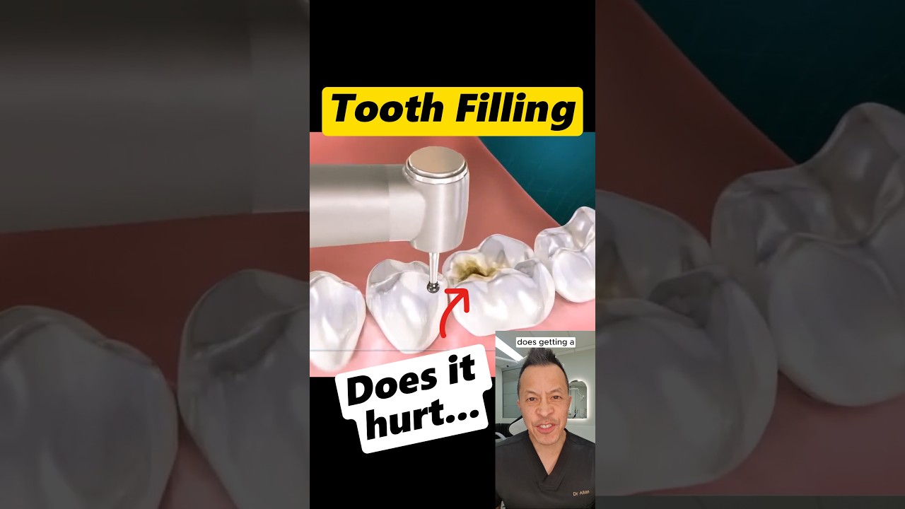 Does Getting a Filling Hurt? The Truth From a Dentist #dentist #dentallan #shorts