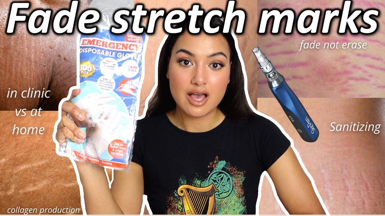 How to fade red stretch marks with microneedling - Video for RESPONSIBLE adults|No before & after