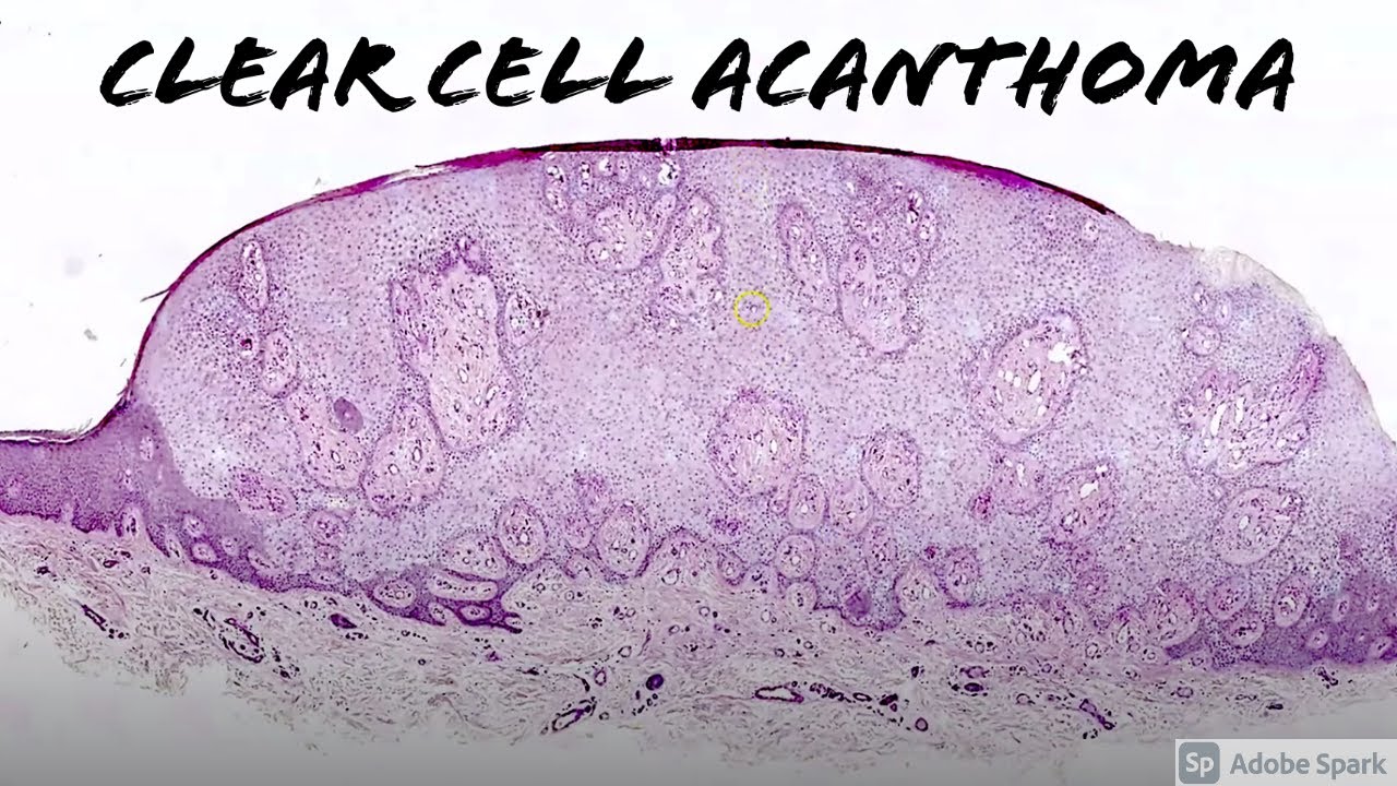 Clear Cell Acanthoma with PAS Stain: 5-Minute Pathology Pearls