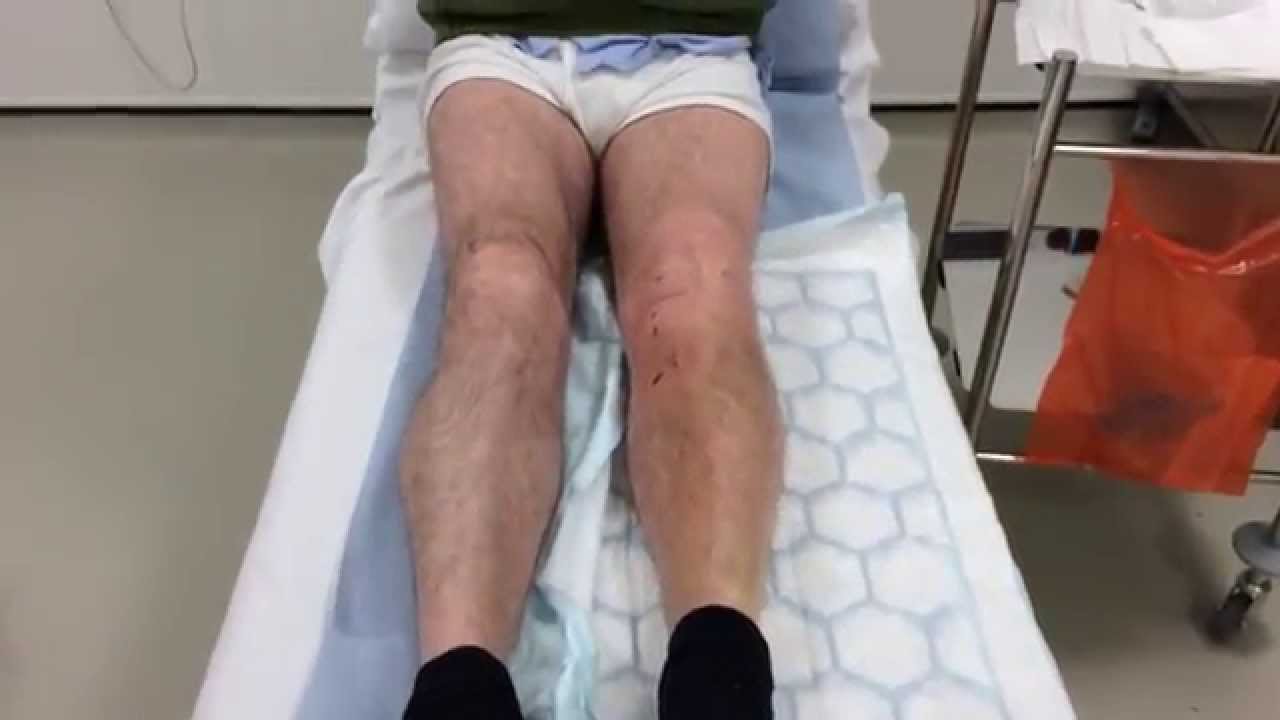 Patient interview at day 11 following HTO and precision bone wedge ( 30 3 15 )