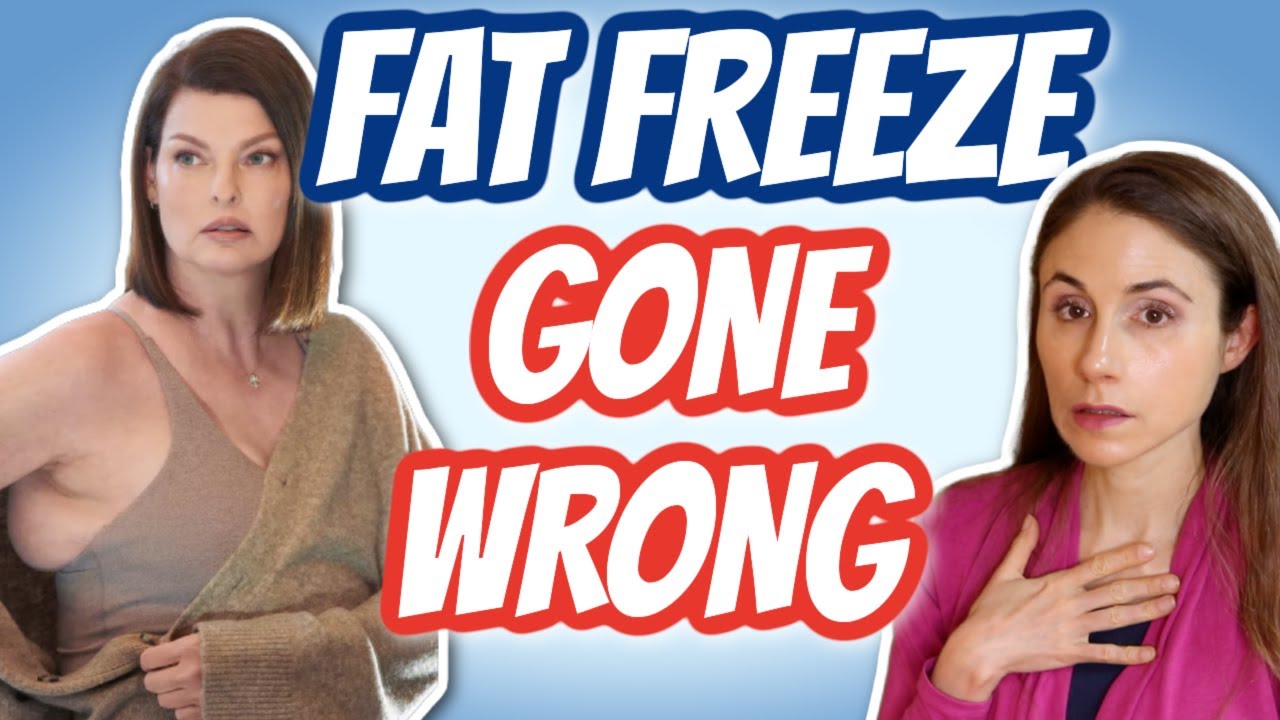 NEW STUDY ON FAT-FREEZING GONE WRONG 😬 @DrDrayzday