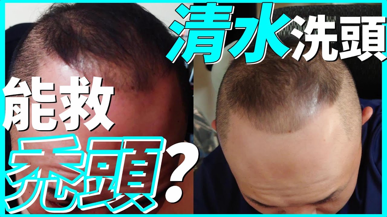 【實測】 不用洗髮精 洗頭 能 拯救 禿頭 ?