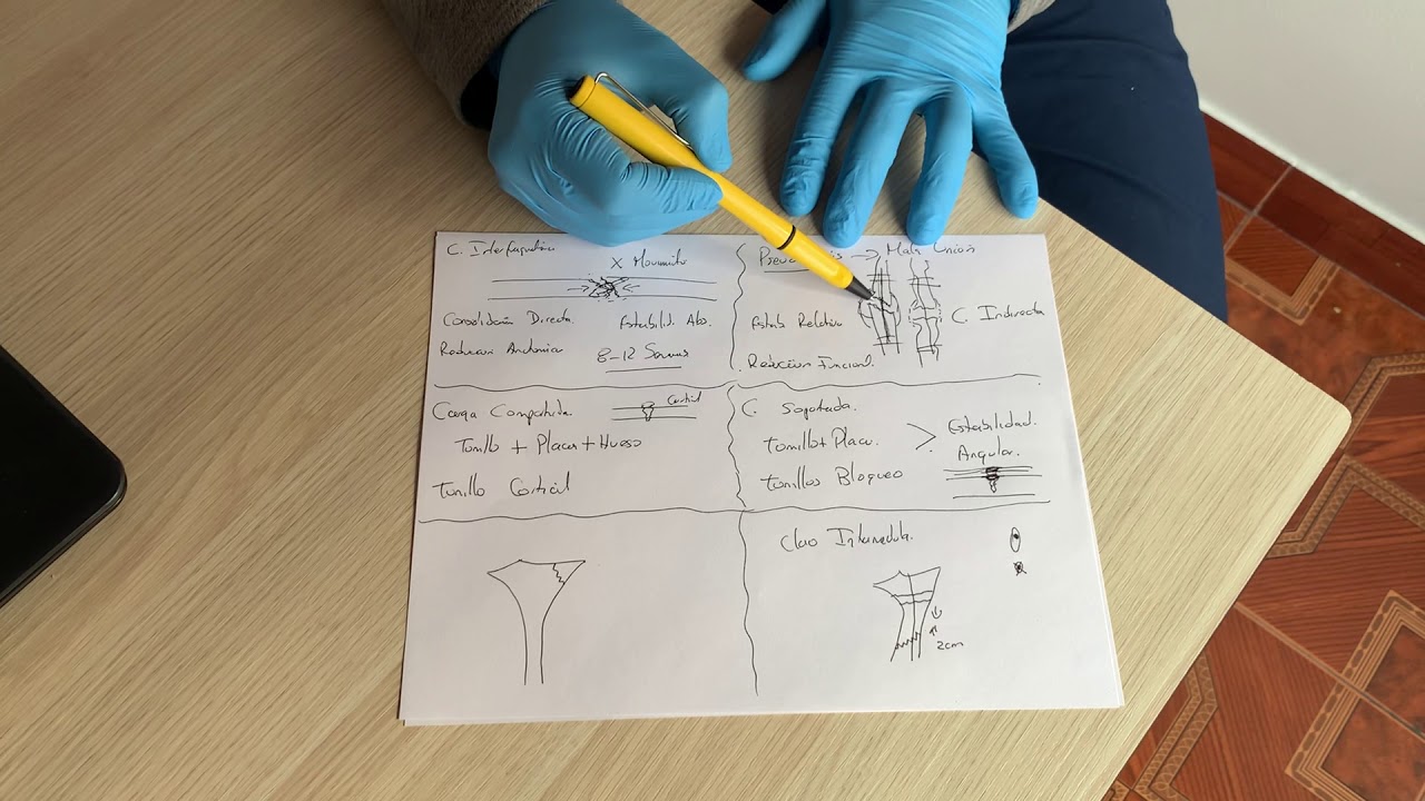 Biomecanica de las Placas, tornillos y Clavos Intramedulares