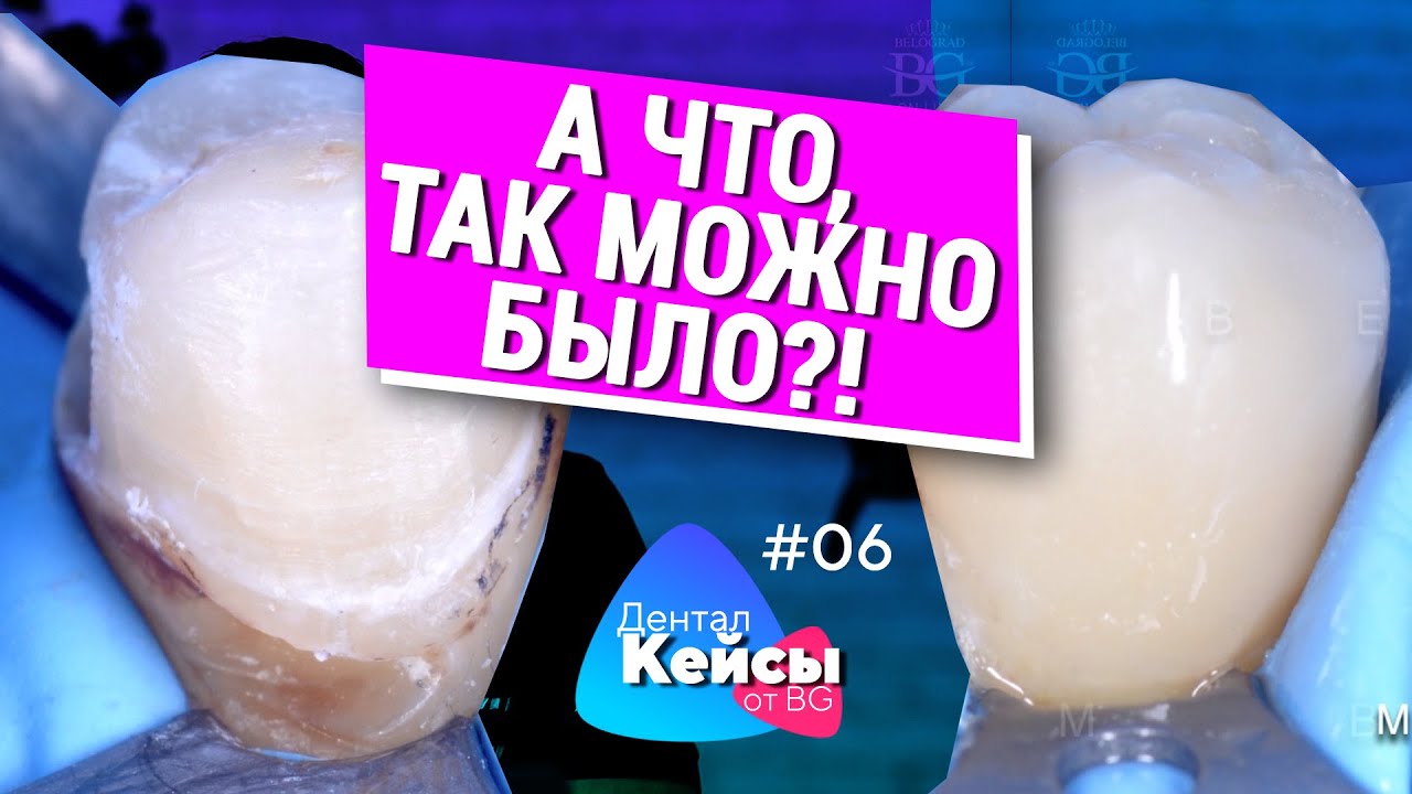Композит и керамика в одной конструкции. Дентал Кейсы от BG. #06