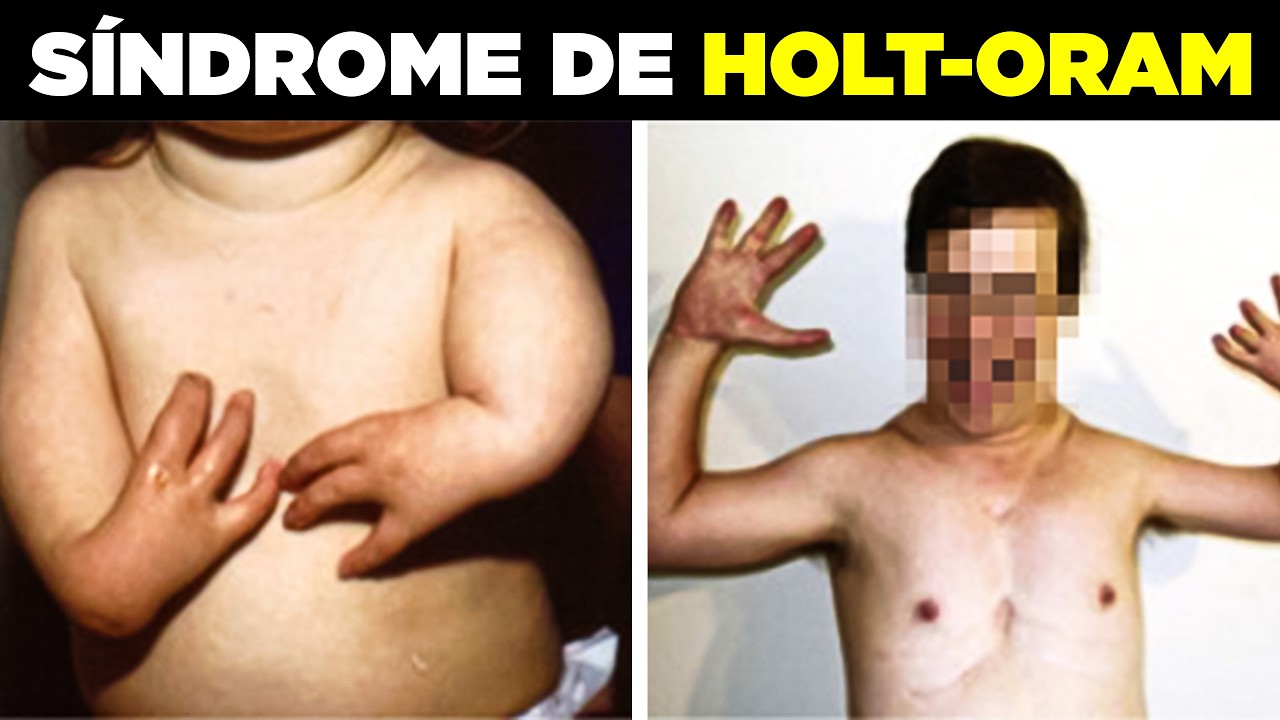 Síndrome de Holt Oram: O Que É e Quais São os Sinais