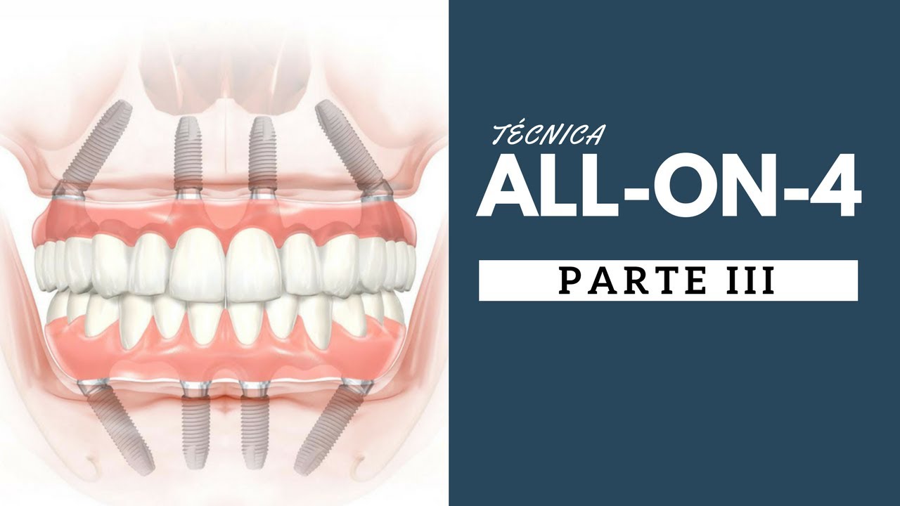 6. TÉCNICA ALL ON 4  - PARTE 3 - O mito de quanto mais implantes melhor