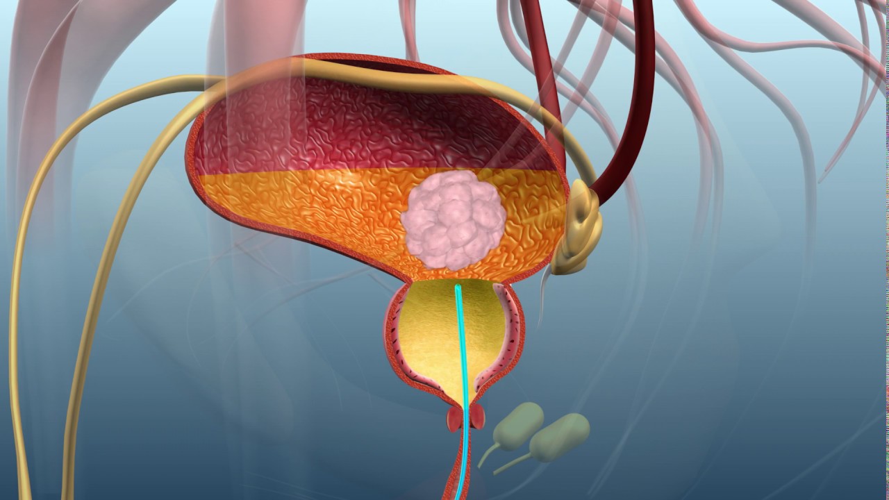 Résection trans-urétrale par laser : Soins minimement invasifs pour troubles de la prostate