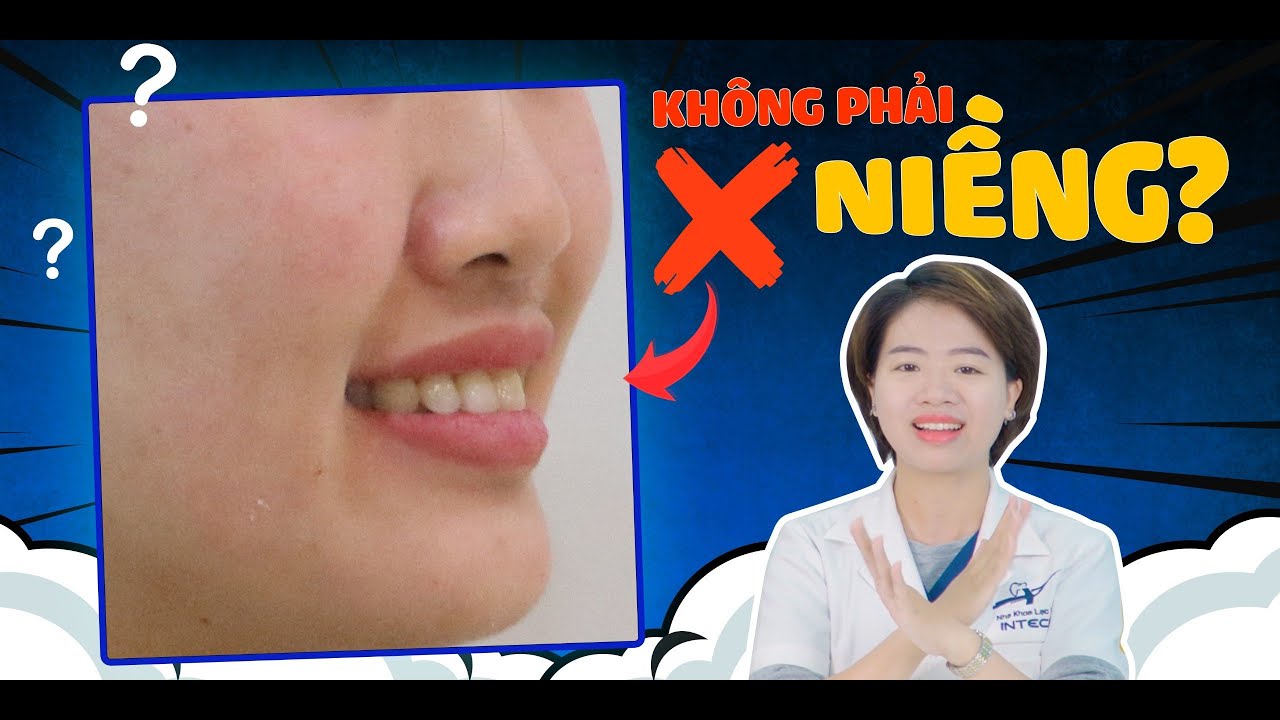 Răng Hô Nhẹ Có Nên Niềng Không? 3 Đặc Điểm Xác Định Răng Hô Nhẹ Có Nên Niềng Không (100% Chính Xác)