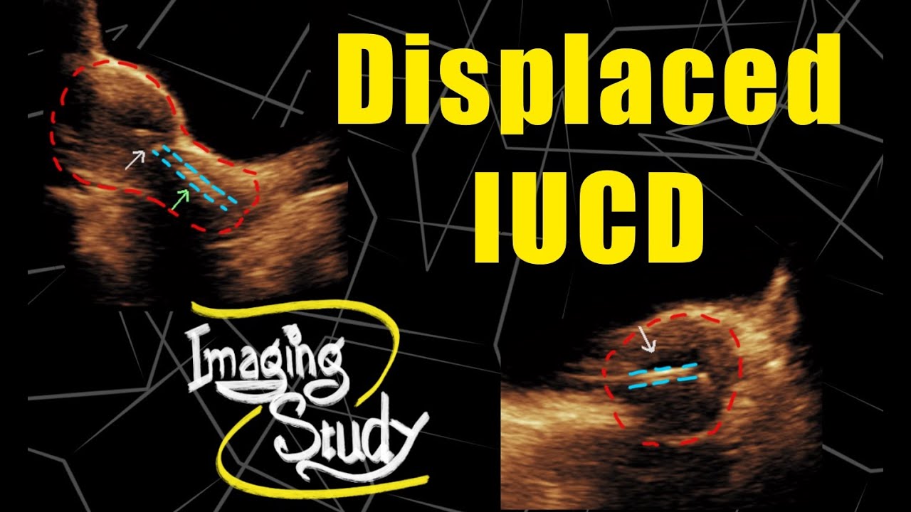 Displaced Intrauterine Contraceptive Device - Copper-T || Ultrasound || Case 113