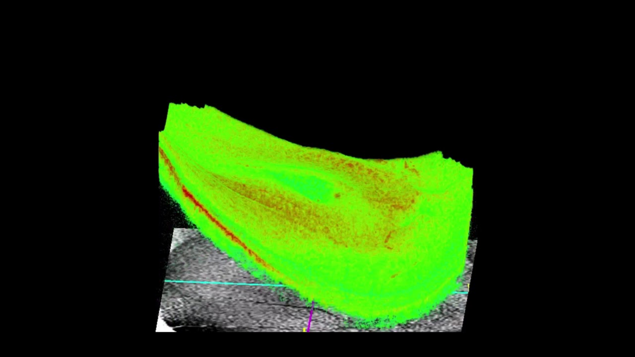 Course in clinical applications of OCT for macular diseases -introduction and types of macular scans