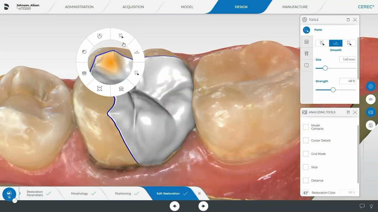 How to design a ceramic onlay on CEREC SW 5.2.8