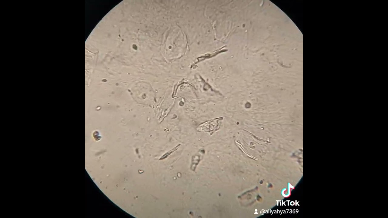 المخاط Mucous في تحليل الادرار #GUE