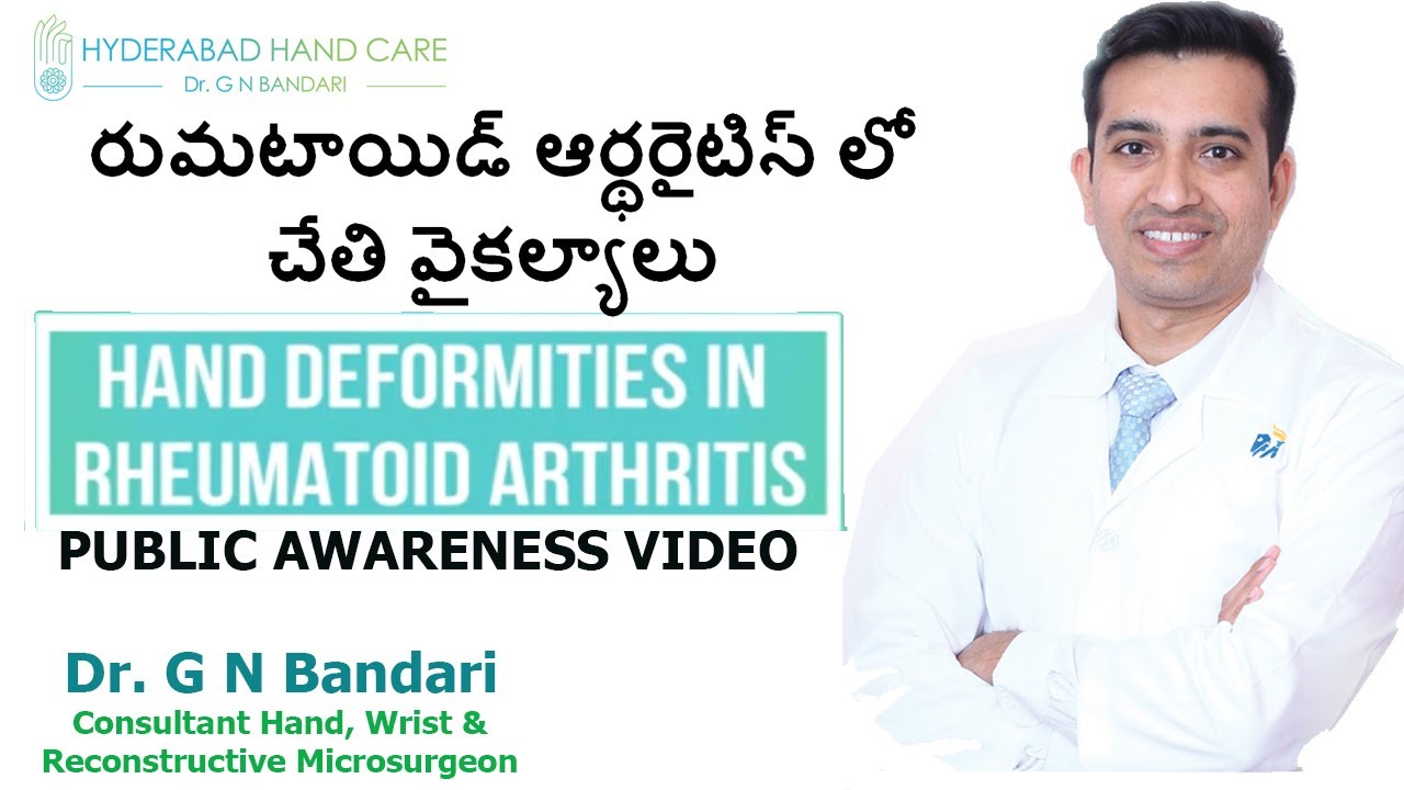 కీళ్ల వాతం లో చేతుల వంకర్లు మరియు వైకల్యాలు | Dr.Gopinath Bandari | Hand and Micro-Surgeon