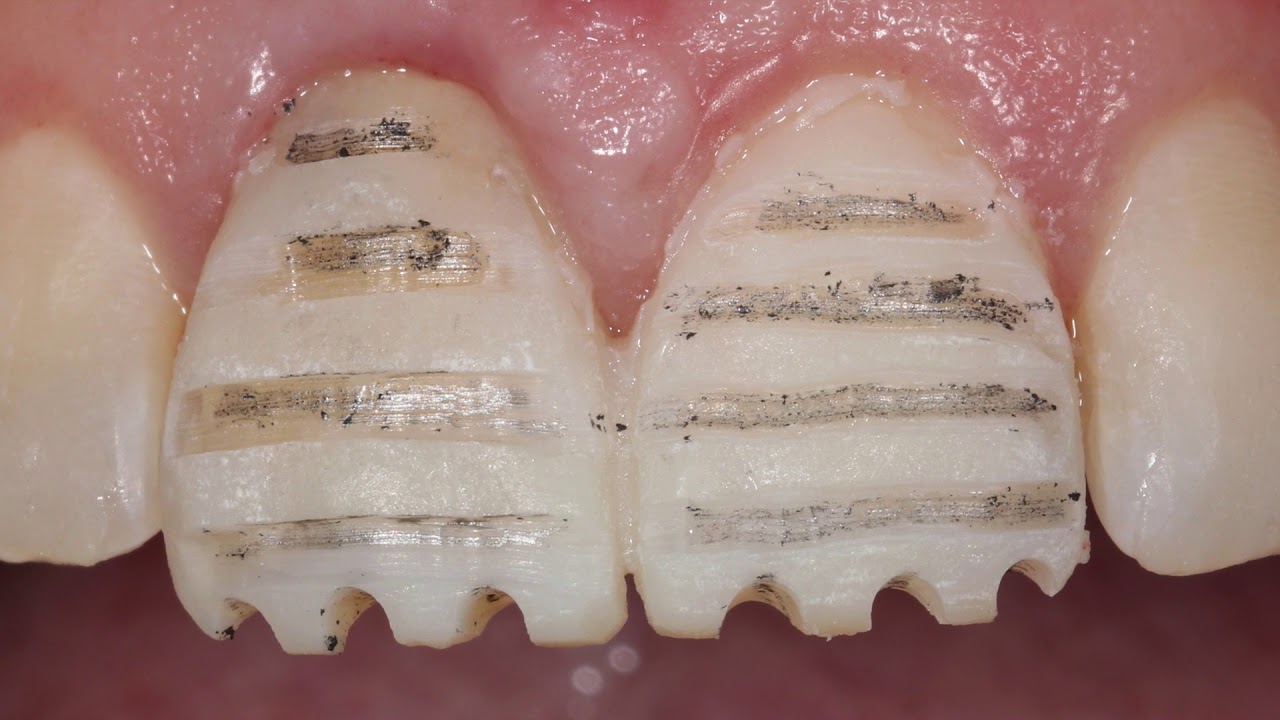 Porcelain Veneer -  Preparation through the mock up