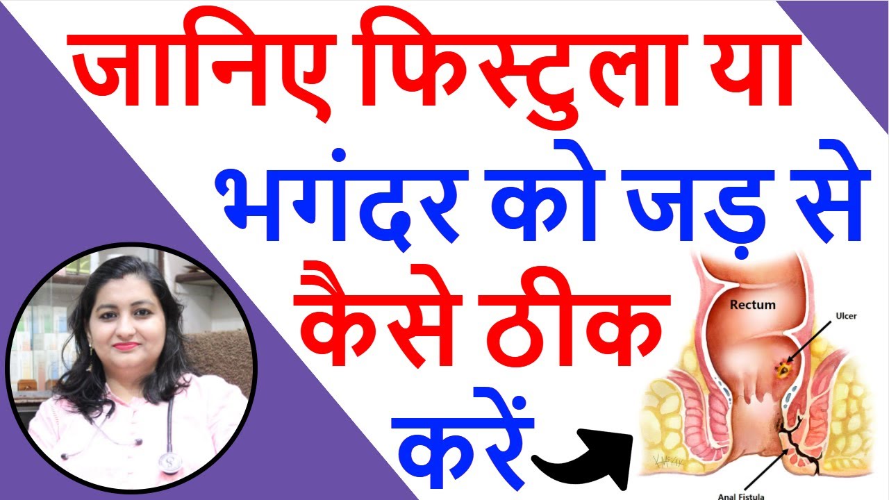 मल द्वार पर होने वाले फिस्टुला का इलाज | Anal Fistula Homeopathic Treatment | Fistula ka jad se ilaj