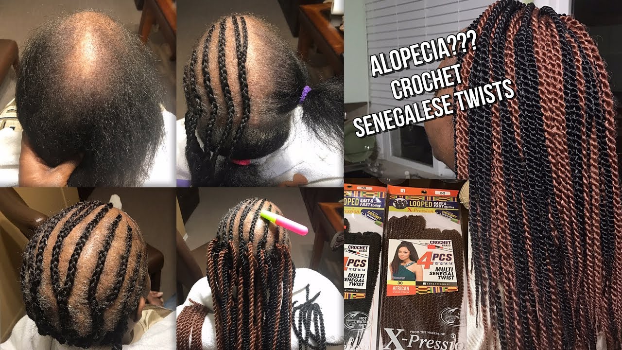 CROCHET SENEGALESE TWISTS ON HAIR WITH PARTIAL ALOPECIA - SENSATIONNEL 4PCS MUTLI SENEGAL TWIST