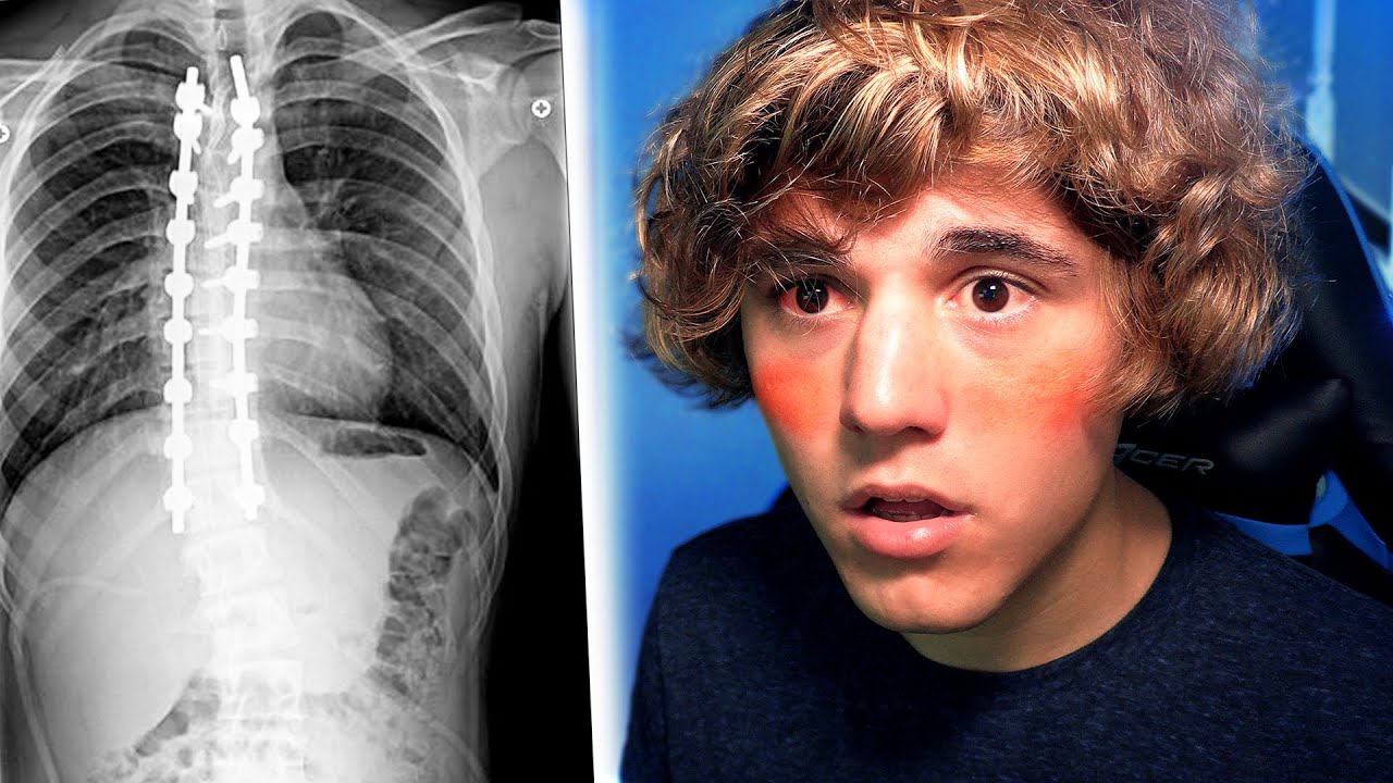 1 Year After Scoliosis Surgery - What to Expect