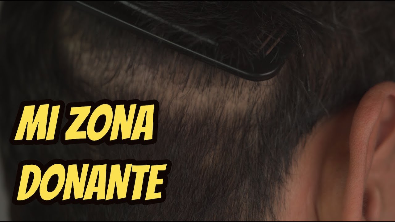 MI CORONILLA, ZONA DONANTE Y RECEPTORA, AL DETALLE | INJERTO CAPILAR EN ESPAÑA