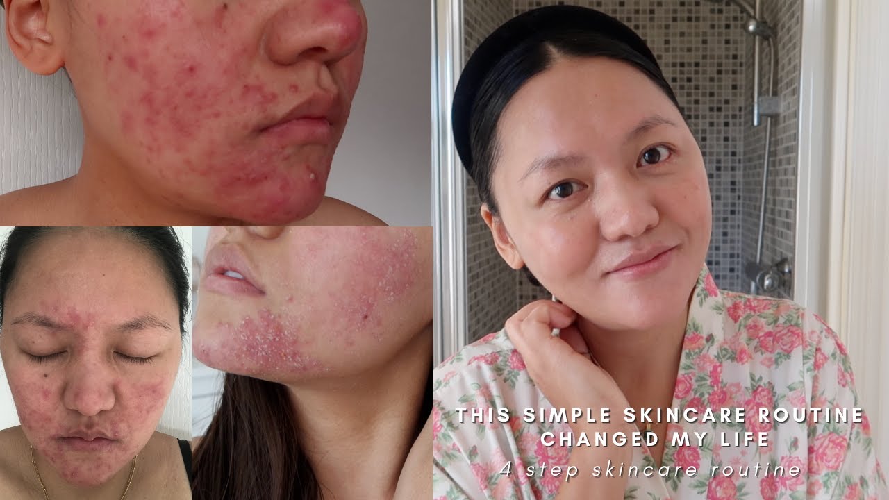 This simple skincare routine cleared my severe acne rosacea | It’s life changing routine