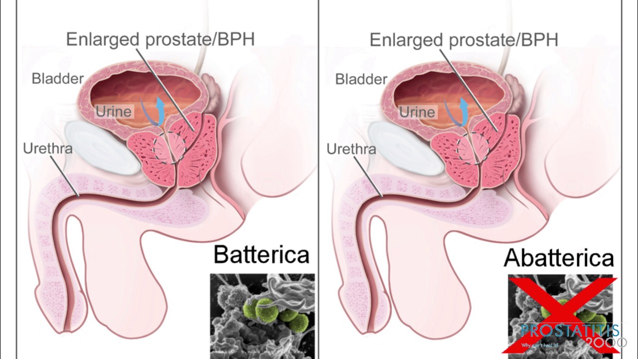 Quale &egrave; la differenza tra prostatite cronica batterica e abatterica?