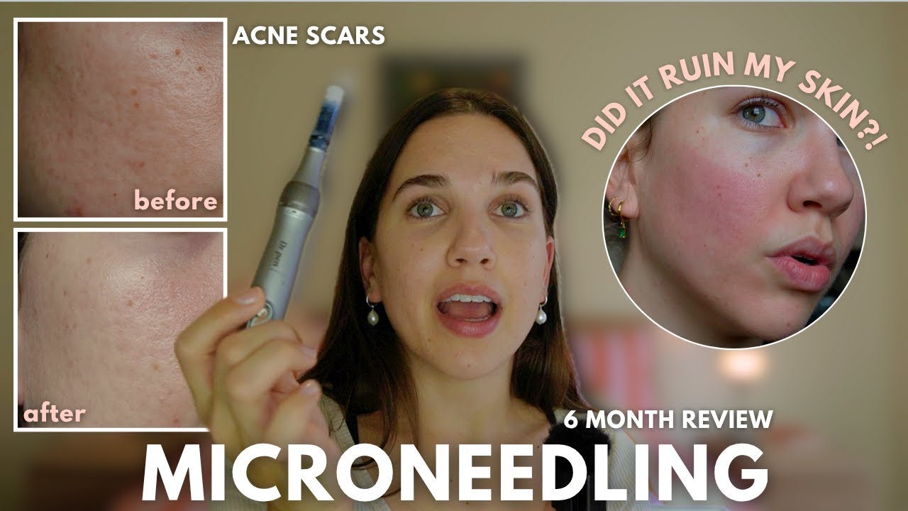 Dr Pen M8S Microneedling Results After 6 Months: Worth It or Not? 😅