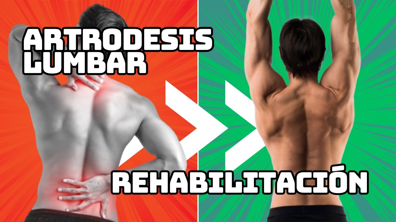 REHABILITACIÓN de ARTRODESIS Lumbar ✅[GUÍA]✅ ¿Qué Ejercicios HACER?
