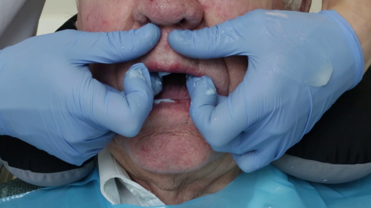 Definitive complete maxillary impression alginate