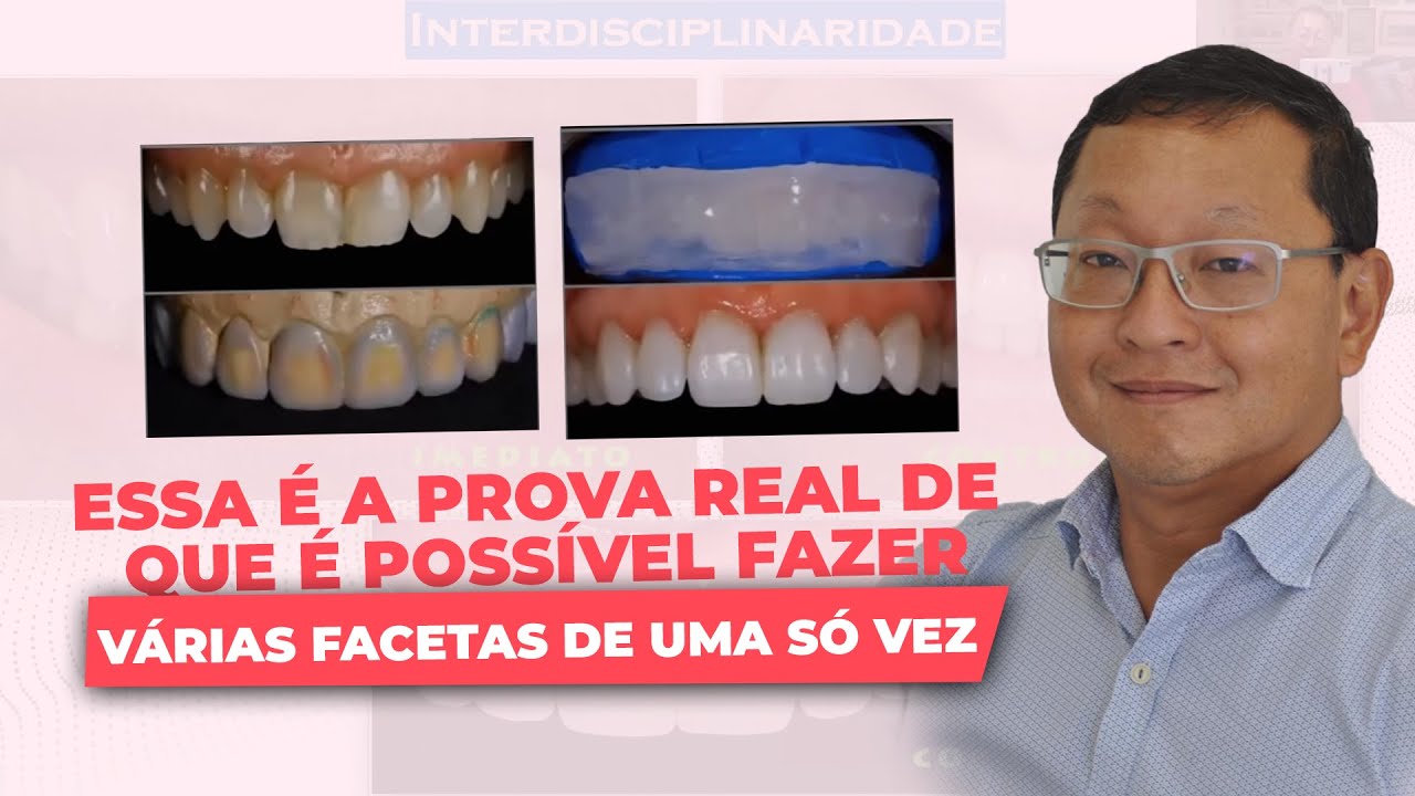 Essa é a prova real de que é possível fazer várias facetas de uma só vez