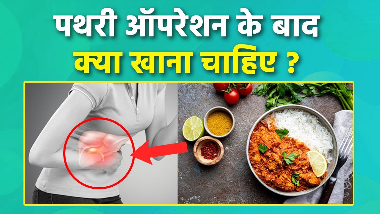 Pathri Operation Ke Baad Kya Khana Chahie | पथरी ऑपरेशन के बाद क्या खाना चाहिए क्या नहीं | Boldsky