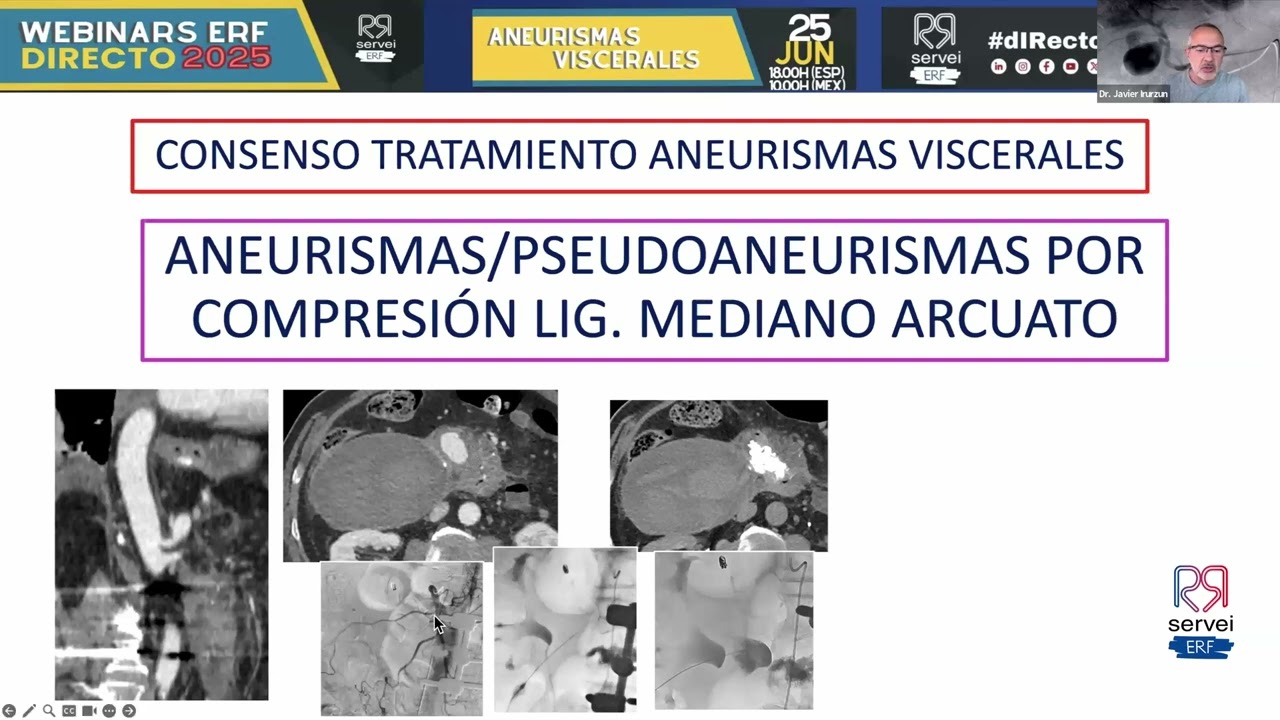 Aneurismas Viscerales - Webinar ERF dIRecto - Junio 2025