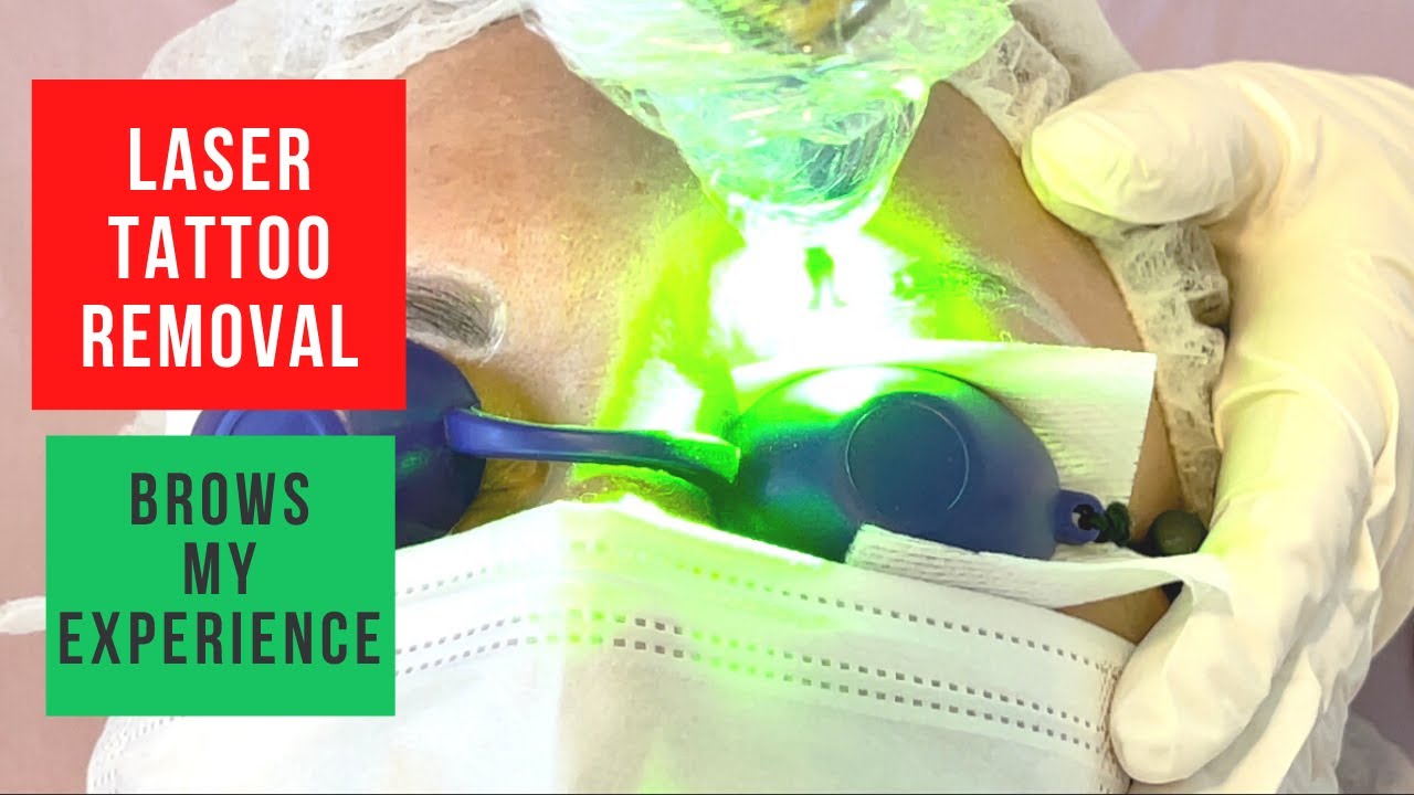 Laser Tattoo Removal. Eyebrows (My experience, full treatment, healing process)