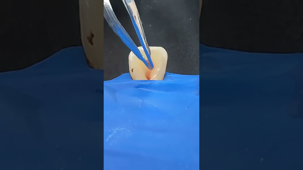 How Dentists Clean a Dead Tooth Nerve #satisfying#ASMR #dentist