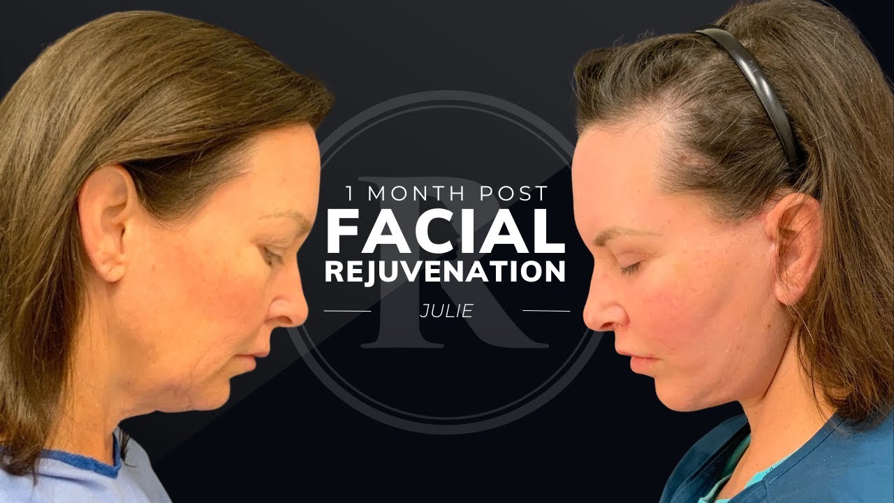 Julie's Story: 1 Month Post Facial Rejuvenation