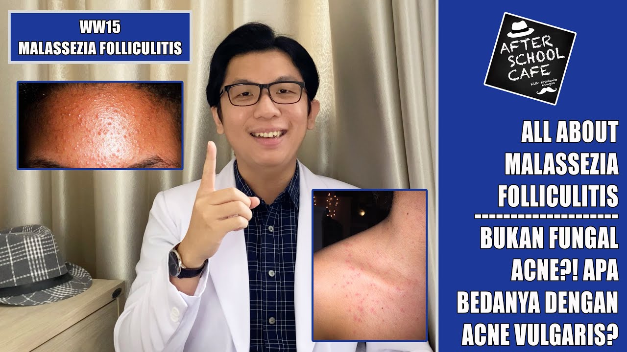 WW15 - JERAWATAN, UDAH DIOBATIN NGGA SEMBUH JUGA? MUNGKIN ITU FUNGAL ACNE (MALASSEZIA FOLLICULITIS)