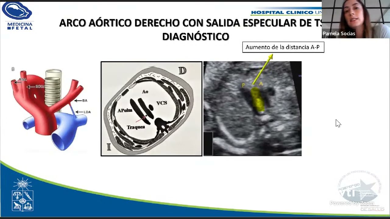 Anomalías del Arco Aórtico Fetal