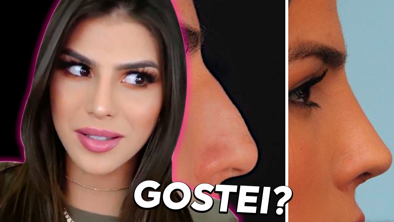 Tudo sobre a minha Rinoplastia******