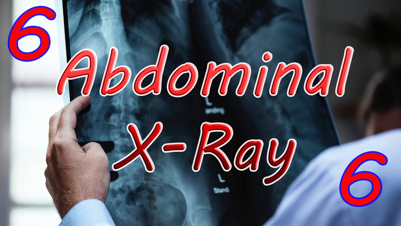 How to read AXR (6)  | Urinary stones & Gallstones | Calcification