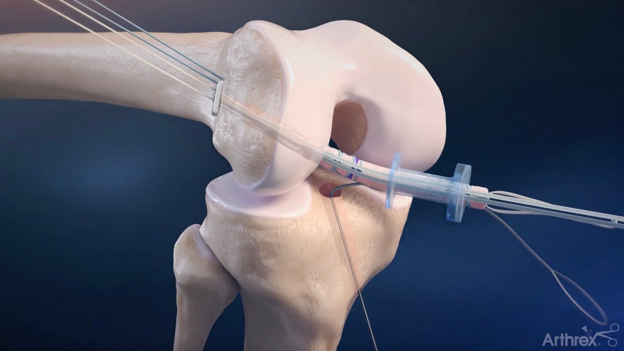 QuadLink All-inside ACLR using FiberTag TightRope II implants and the InternalBrace technique