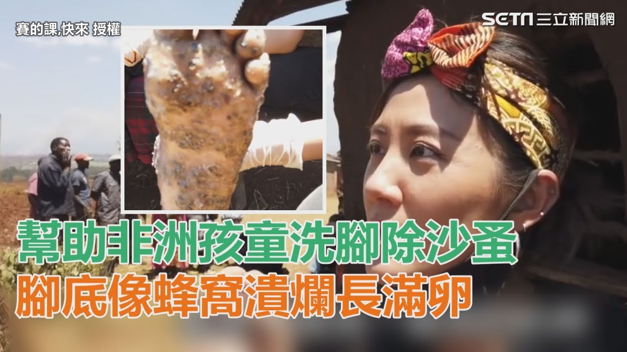 幫助非洲孩童洗腳除沙蚤　腳底像蜂窩潰爛長滿卵｜三立新聞網SETN.com