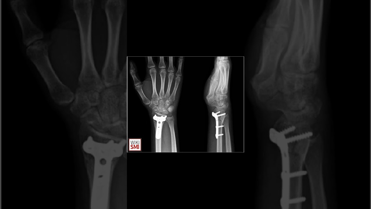 🎯 Flexor Pollicis Longus Rupture &ndash; Signs, Diagnosis & Fix #meded #handsurgery #anatomy #physio #ATC