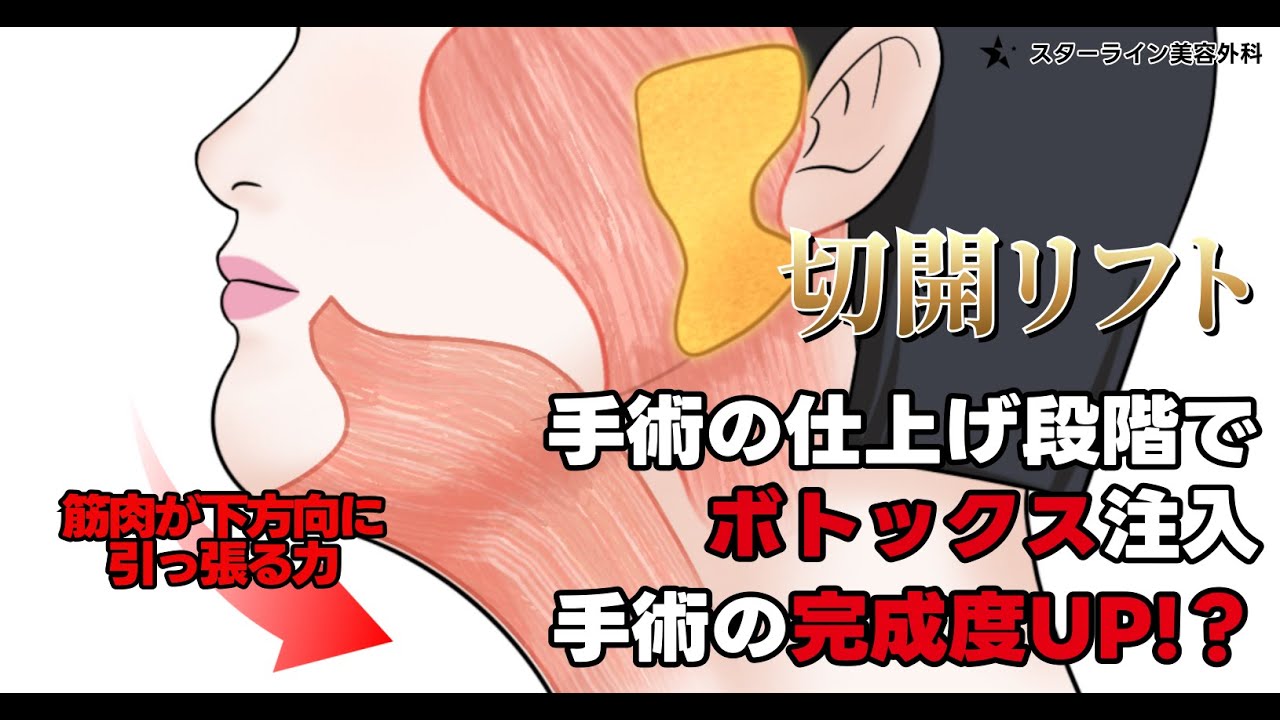 【切開リフト】 手術の仕上げ段階で戦略的にボトックスを注入！？