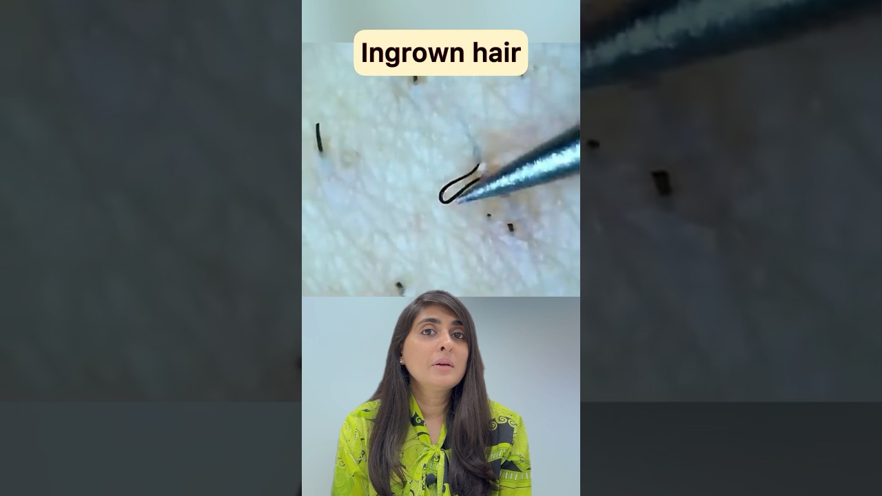 Ingrown hair removal | Ingrown hair | Ingrown hair removal satisfying