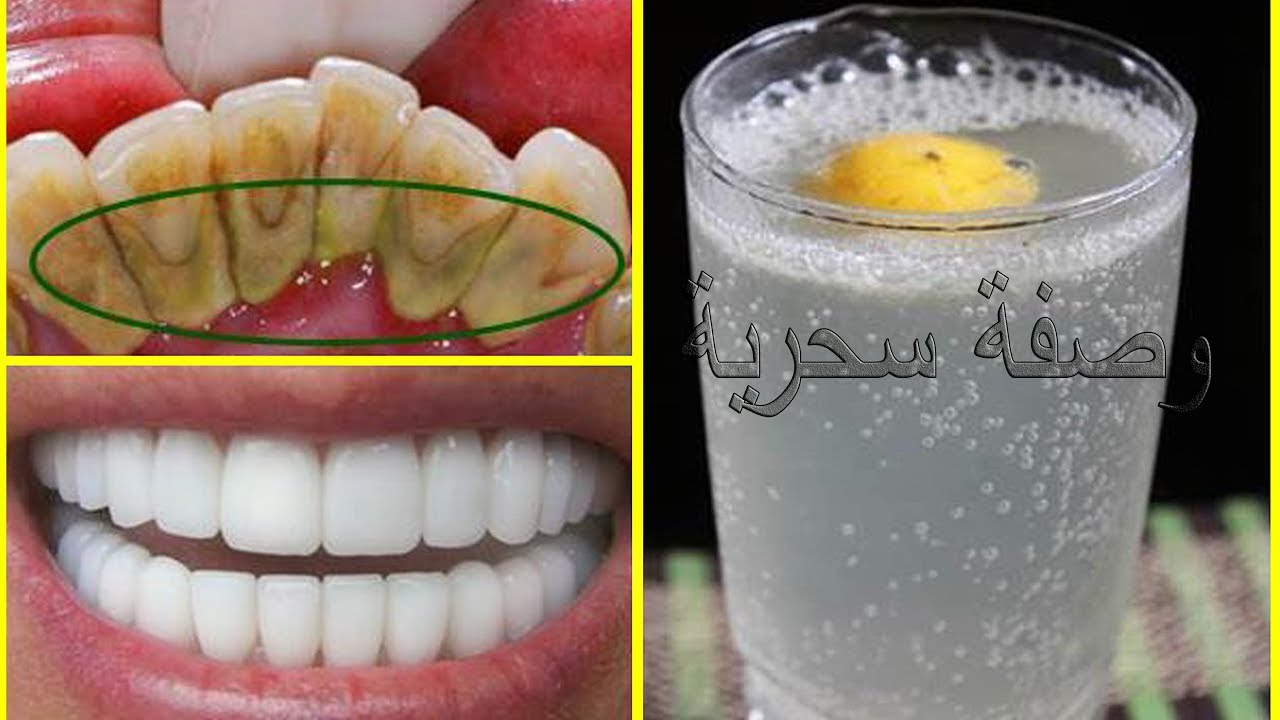 أقسم بالله لن تلجأ لطبيب الأسنان لتبييض الأسنان ولا لإزالة الجير سيسقط وحده بعد المضمضة بهدا المحلول