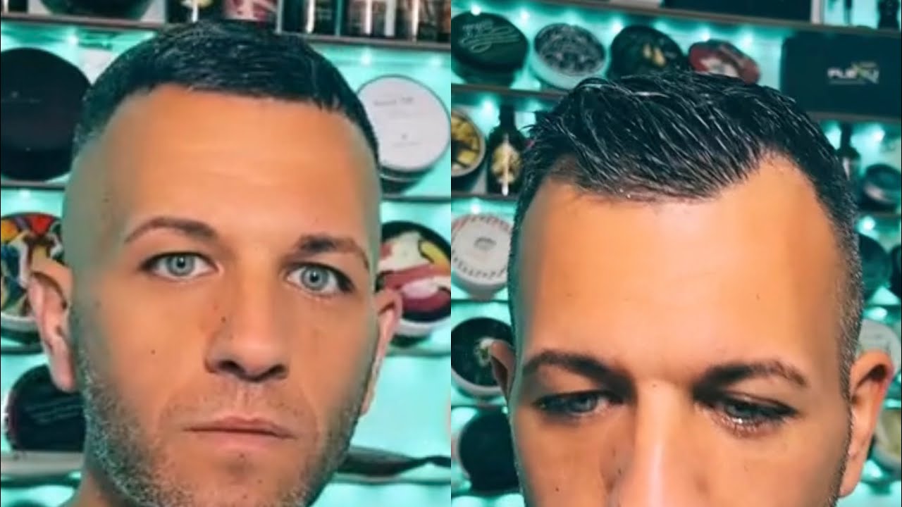 Come coprire una stempiatura senza trapianto di capelli ! Semplice e veloce