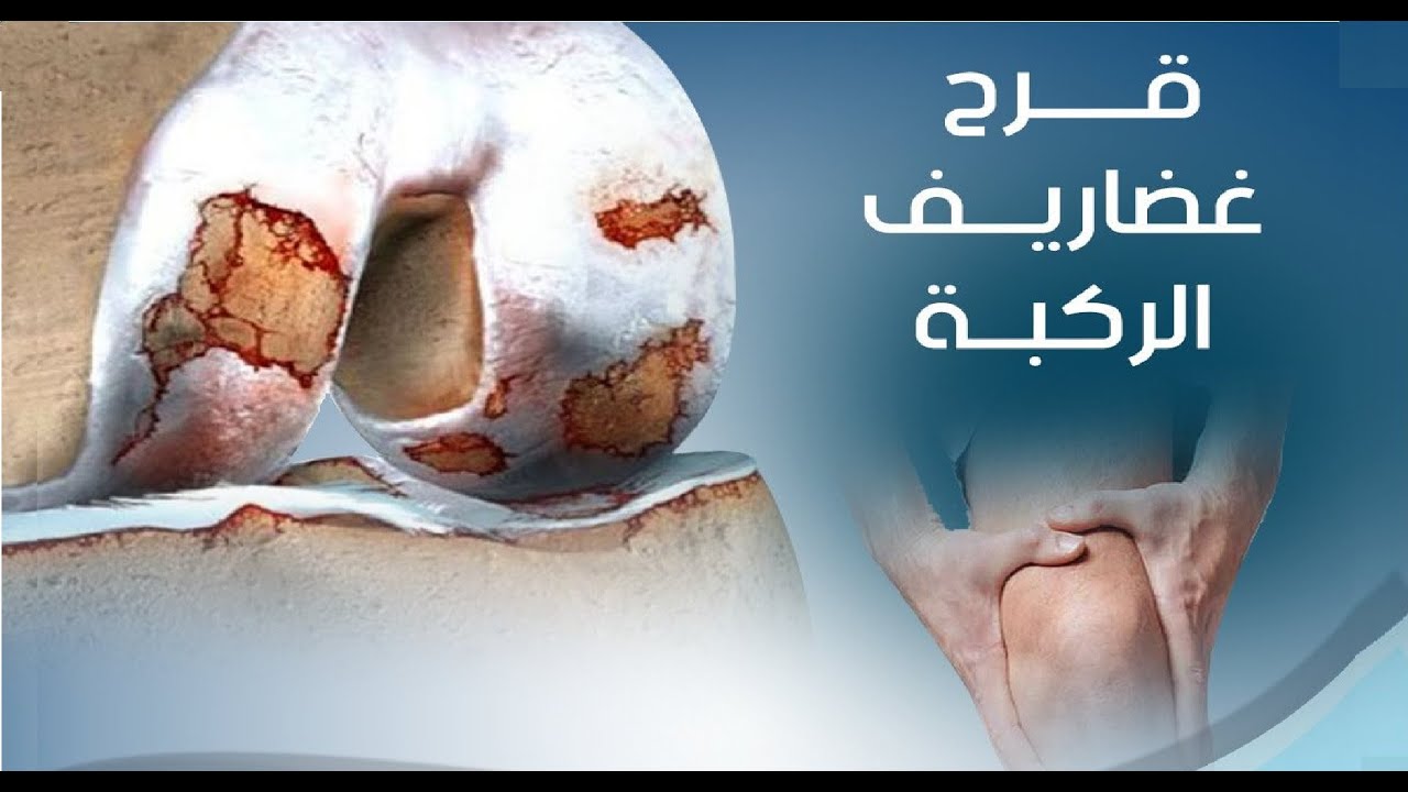 هل الجراحة الحل الوحيد لقرحة غضاريف الركبة؟ اهم المعلومات والأرشدات !!