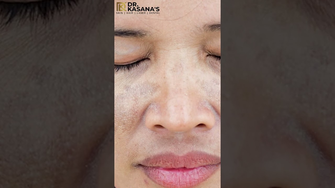 Diet to Reduce Skin Pigmentation Skin Pigmentation  Perfect Diet Plan For Dr. Lalit Kasana Episode 2