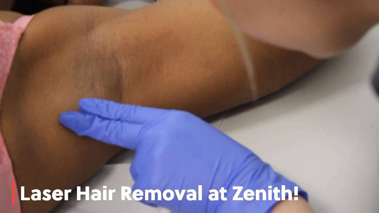 Laser Hair Removal at Zenith