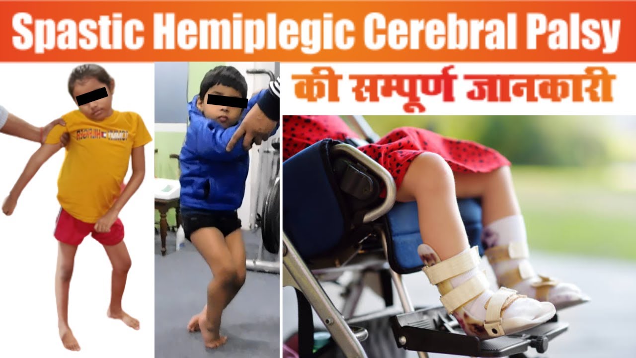 स्पास्टिक हेमिप्लेजिक सेरेब्रल पाल्सी की सम्पूर्ण जानकारी  | Spastic Hemiplegic Cerebral Palsy