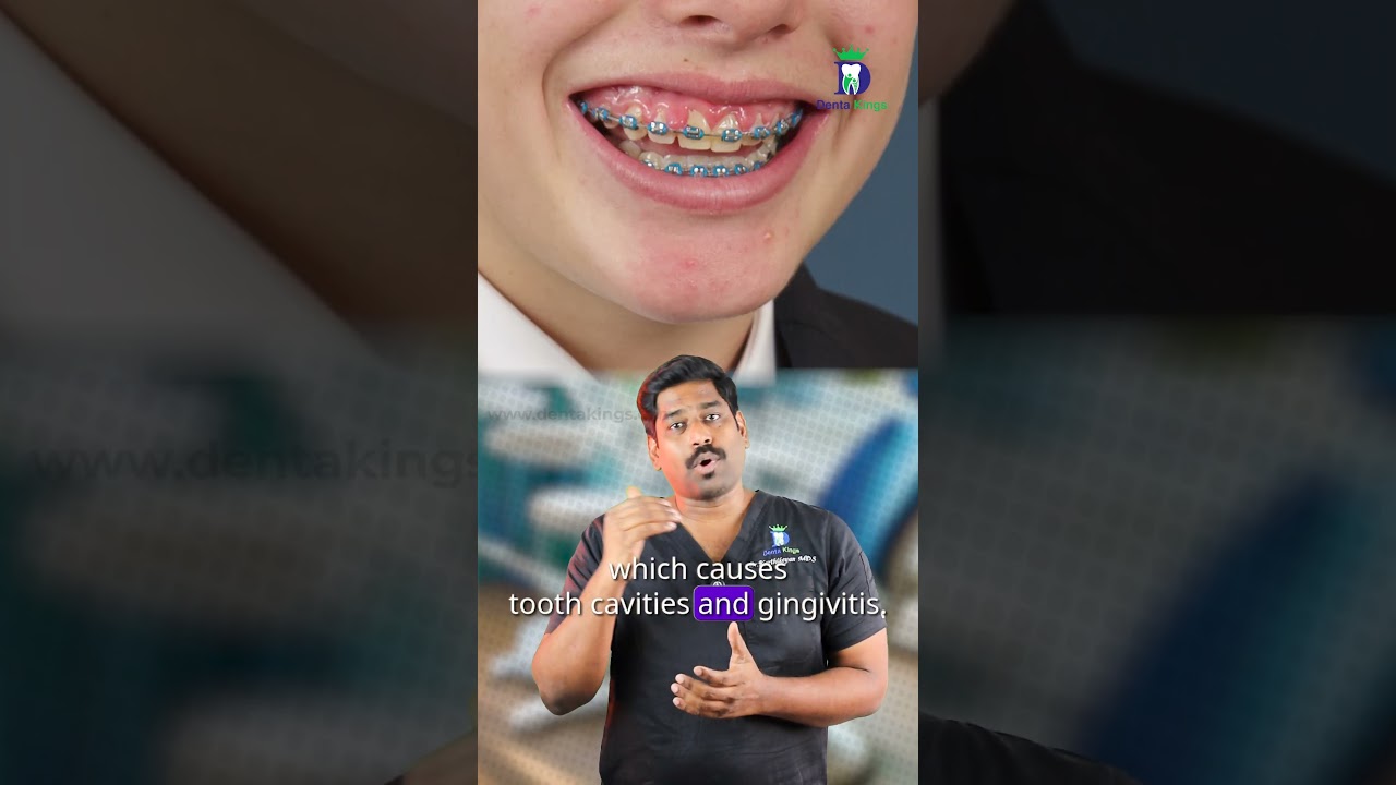 Can braces cause swollen gums? - Braces gingivitis | Dr.karthikeyan | Denta Kings